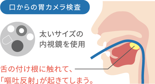 口からの胃カメラ検査